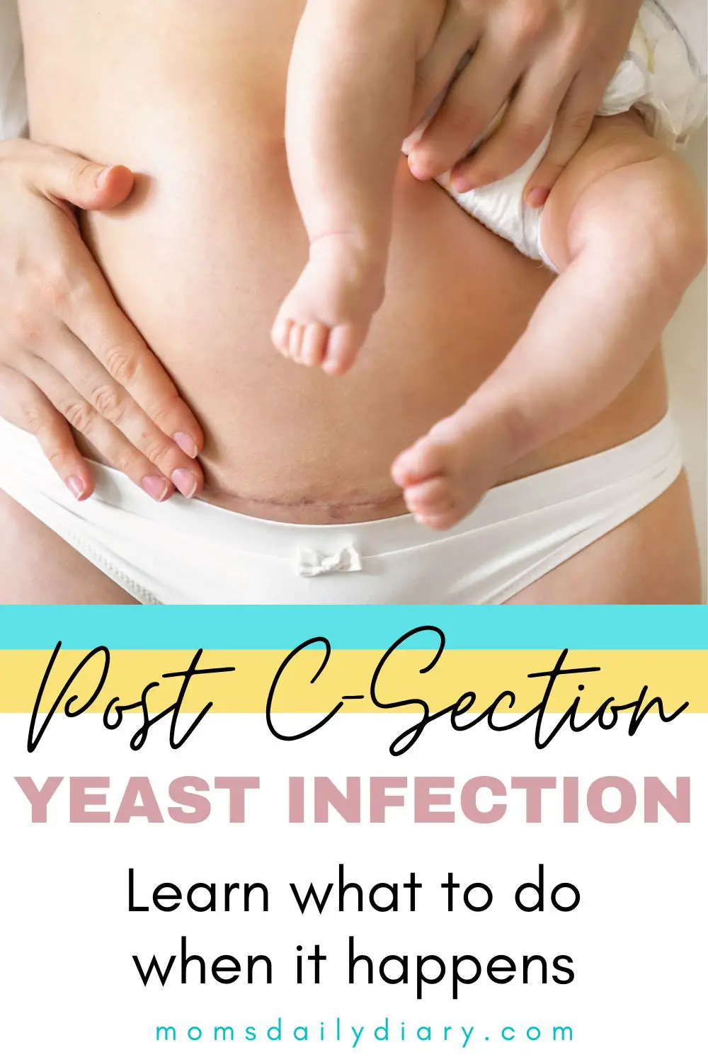 Post-c-Section-yeast-nfection